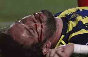 إصابة مرعبة للاعب فنربخشة