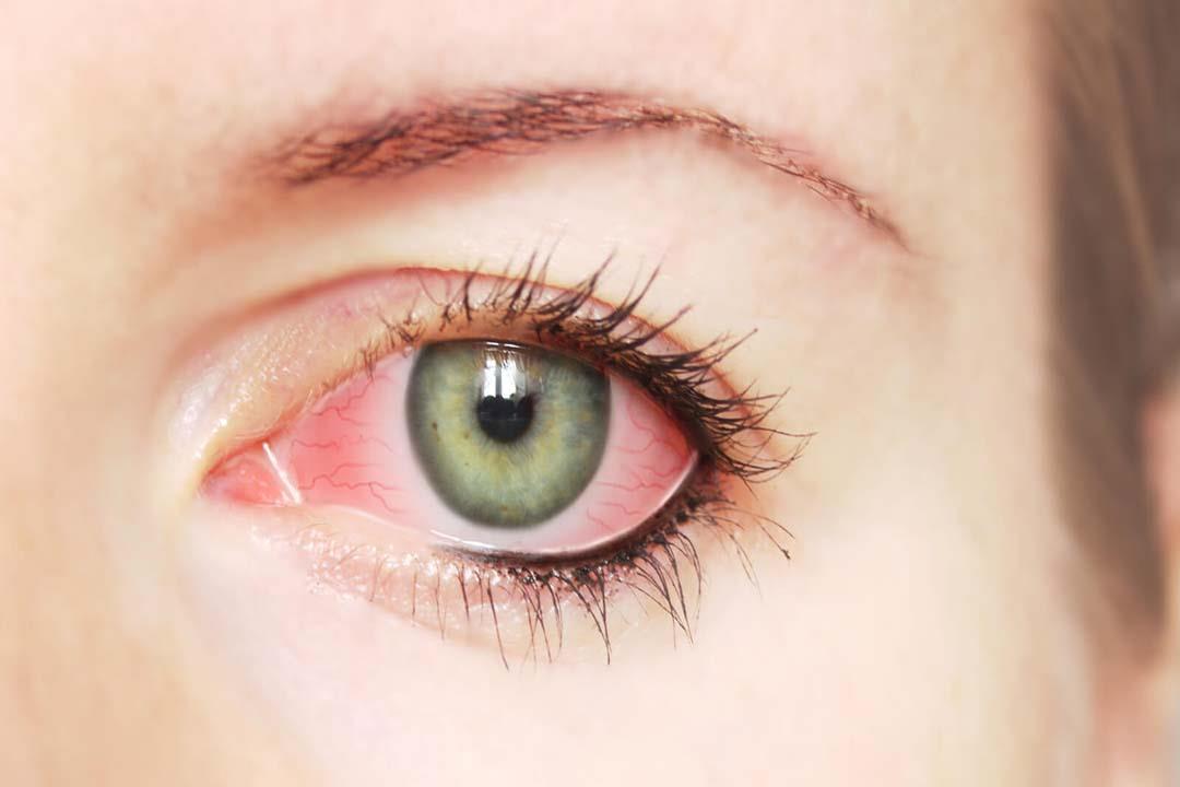 التهاب ملتحمة العين                                                                                                                                                                                     