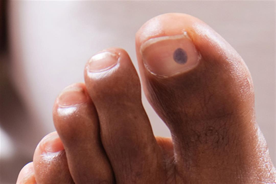 493ss_thinkstock_rf_cellular_blue_nevus