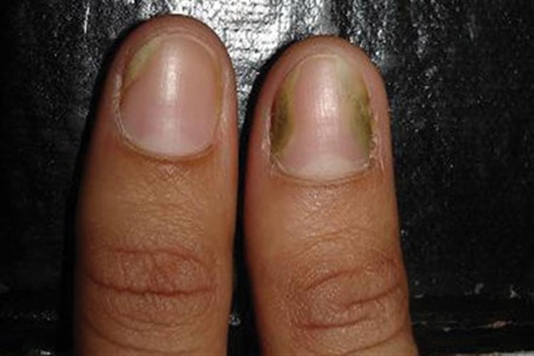 Onychomycosis25