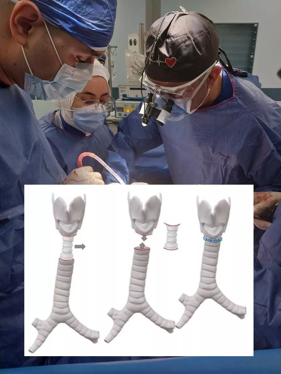 نجاح جراحة دقيقة لاستئصال جزء من القصبة الهوائية