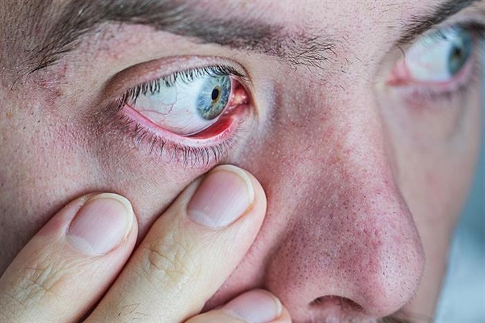 مخاطر يسببها ارتفاع ضغط الدم على العين- 4 أعراض مزعجة