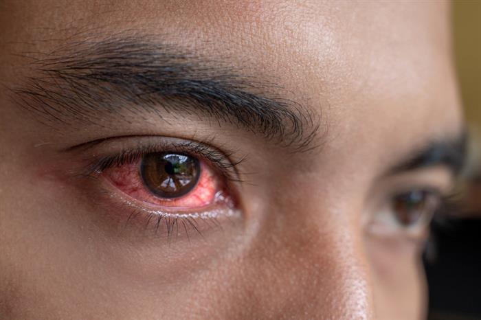 انتبه- احمرار العين يكشف إصابتك بهذا المرض