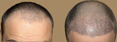 Patient - Before & After the Hair Transplant Surgery