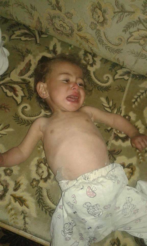 مجاعة مضايا السورية                                                                                                                                                                                     