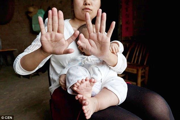 طفل صيني يولد بـ 31 أصبعًا في يديه وقدميه (1)                                                                                                                                                           
