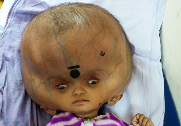 عملية لطفل هندي محيط رأسه 96 سنتيمتراً                                                                                                                                                                  