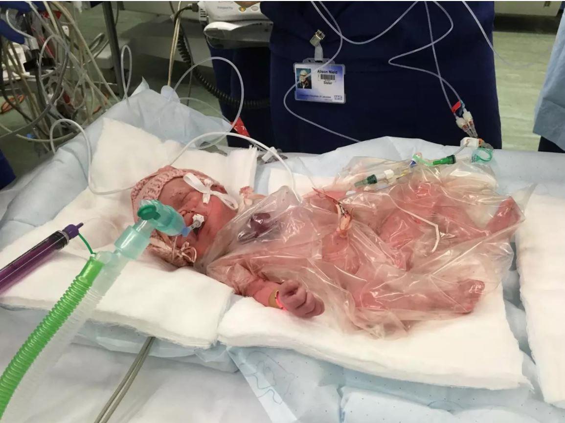 جراحة نادرة لرضيعة وُلدت بقلب خارج جسمها (1)                                                                                                                                                            