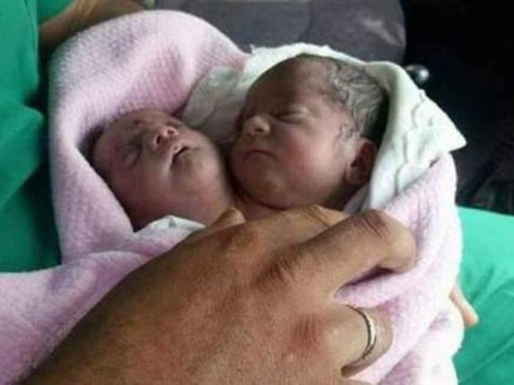 ولادة طفل بـ "رأسين" في سوريا                                                                                                                                                                           