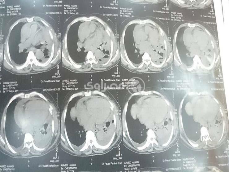 جراحة شق صدر لعجوز بمستشفى حكومي (1)                                                                                                                                                                    