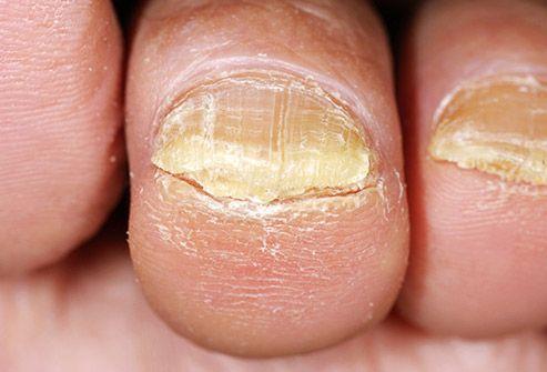 فطريات الأظافر تحتاج إلى علاج فطريات الأظافر تحتاج إلى علاج