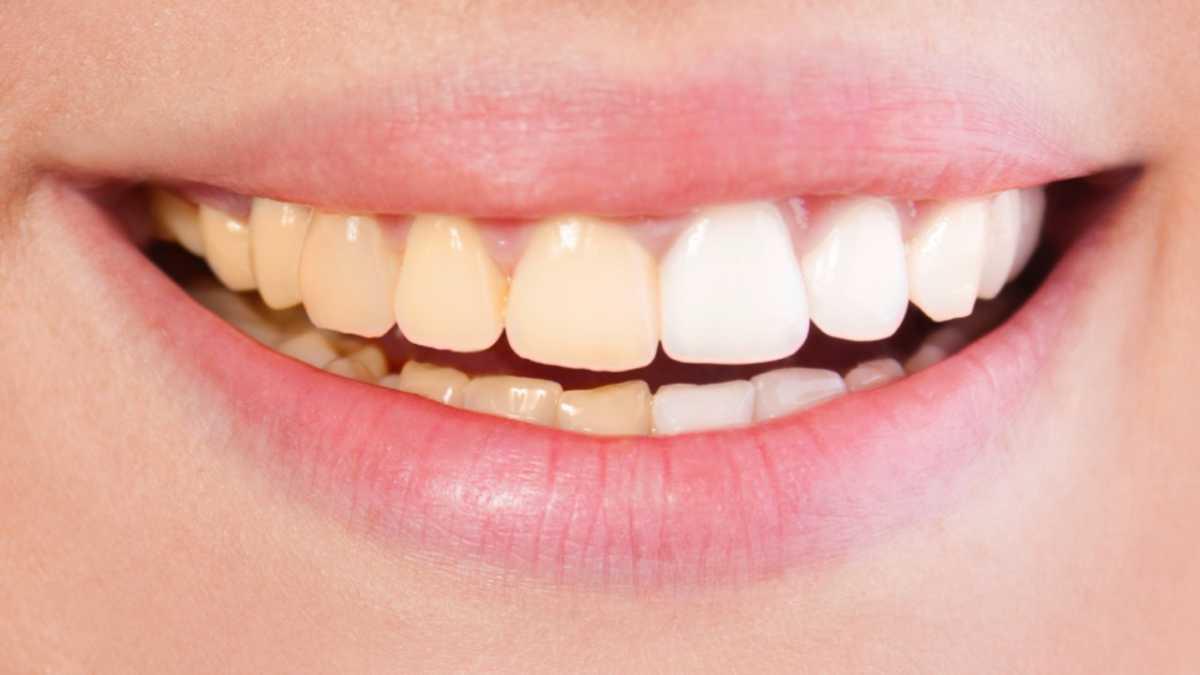 لون الأسنان الصحية.. بيضاء أم صفراء؟