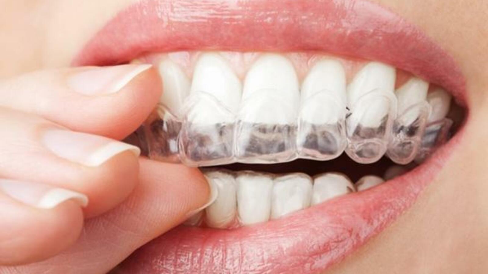 ما تريد معرفته عن "الأسنان الطباشيرية" | مصراوى