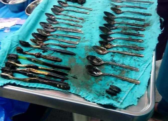 "20 ملعقة و4 شوك و7 فرش".. رئيس الفريق الطبي يكشف تفاصيل عملية "شاب المنصورة" (حوار) "20 ملعقة و4 شوك و7 فرش".. رئيس الفريق الطبي يكشف تفاصيل عملية "شاب المنصورة" (حوار)