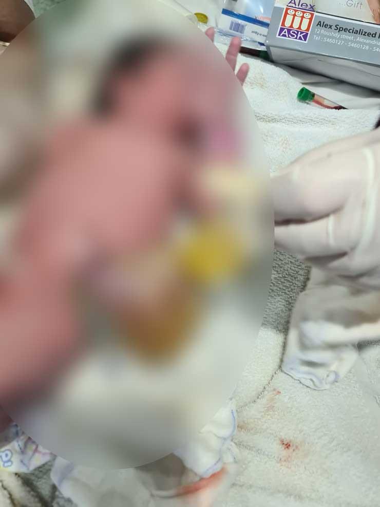 جراحة لمولود مصاب بعيب خلقي بخروج أمعاء من جدار البطن