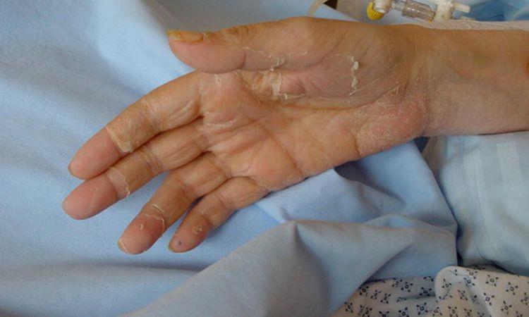 ما هي متلازمة الصدمة التسممية؟ ما هي متلازمة الصدمة التسممية؟
