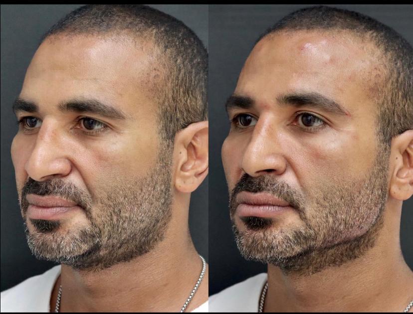 أحمد سعد قبل وبعد التجميل