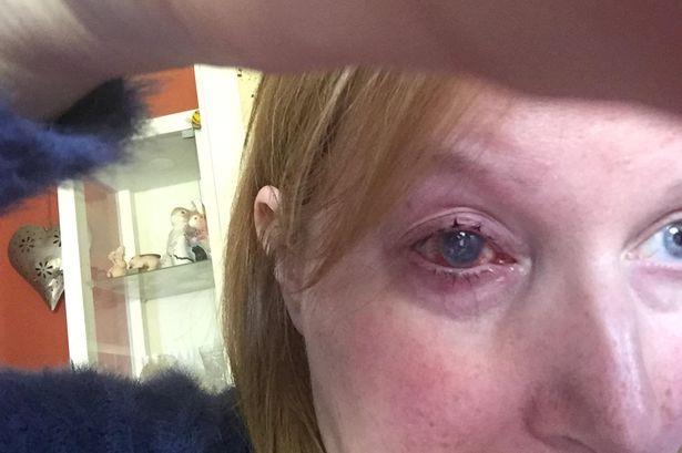 امرأة تفقد عينها اليسري بعد إصابتها بعدوي- والسبب مفاجأة