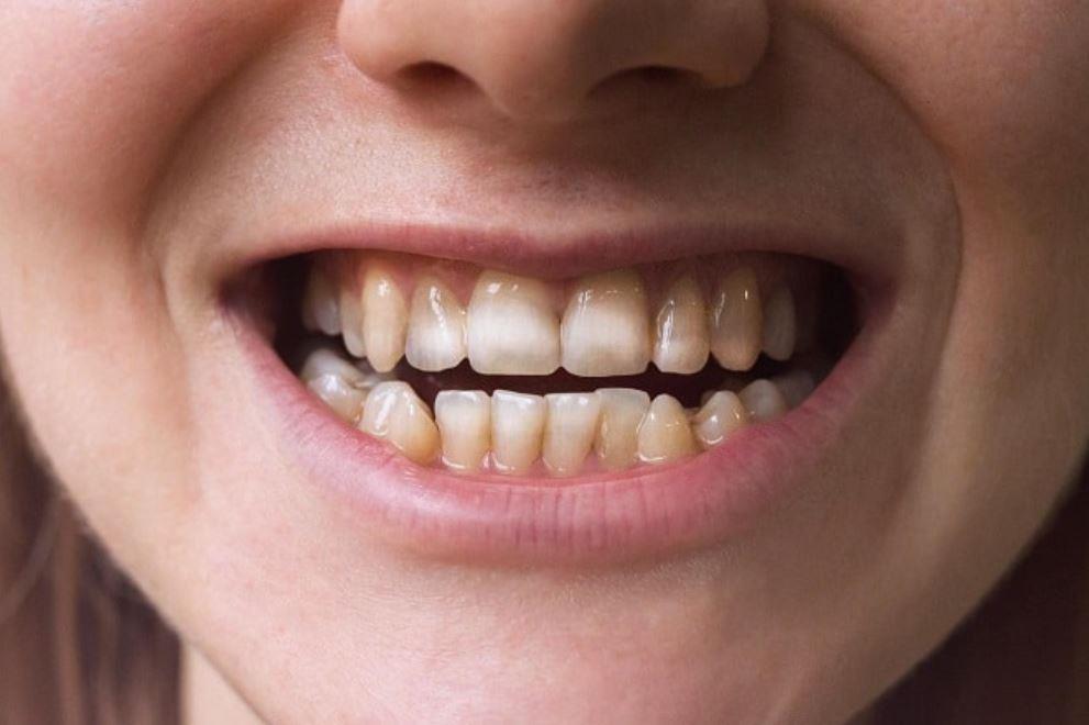 التأثير علي صحة الأسنان، وذلك نظرَا لتأثيرها السلبي على كالسيوم الجسم