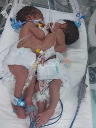 ولادة نادرة بمستشفى في أسيوط