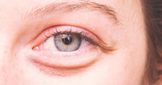 ارتفاع الكوليسترول وصحة العينين