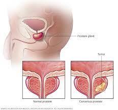 سرطان البروستاتا