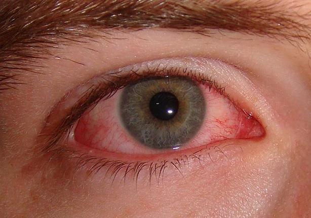 التهاب المفاصل والعينين