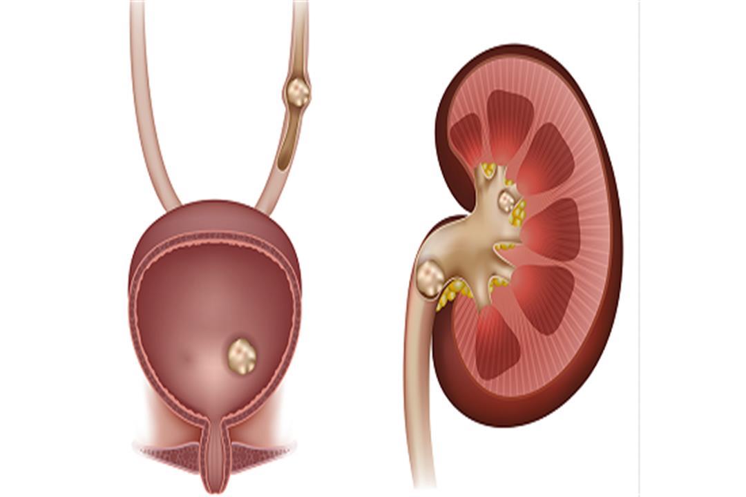 حصوات الكلى                                                                                                                                                                                             