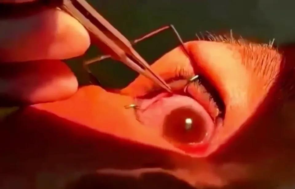 امرأة صينية يخرج من عينها أكثر من 50 دودة