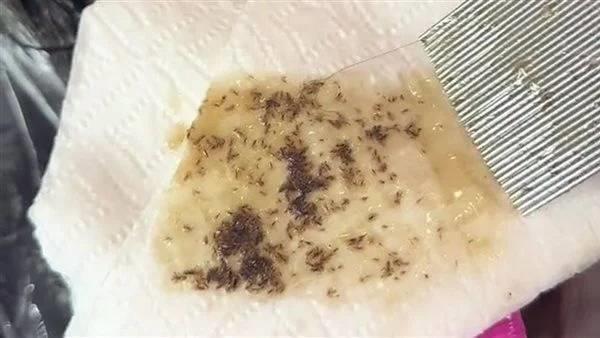  استخراج مئات الحشرات من شعر طفلة بعد سنوات من المعاناة