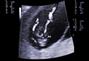 تغيرات الجنين في الشهر الثاني من الحمل