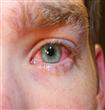 احمرار العين قد يُشير إلى الإصابة بالتهاب الغشاء ا