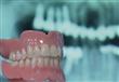 زراعة الأسنان.. فوائدها ومخاطرها