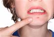 هل معجون الأسنان يحارب البثور؟ 
