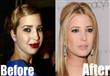 Ivanka-Trump-Plastic-Surgery-Photo copy