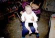 طفل صيني يولد بـ 31 أصبعًا في يديه وقدميه (3)                                                                                                                                                           