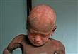 مرض جلدي نادي يحول طفل إلى تمثال حجري