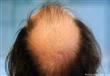 دراسة: زراعة الشعر قد تزيد جاذبيتك لدى الآخرين