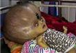 عملية لطفل هندي محيط رأسه 96 سنتيمتراً                                                                                                                                                                  