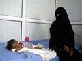 يمنية قرب طفلها الذي يتلقى العلاج في احد مستشفيات 