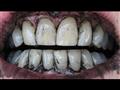 8 طرق لتبييض الأسنان الصفراء منها الفحم 