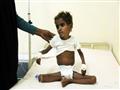 طفل يمني يعاني من النقص الحاد في الغذاء خلال تلقيه