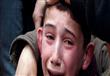 بالصور -  اطفال سوريا يعانون متلازمة الدمار البشري..  مأساة لم يشهدها طبيب من قبل  (2)                                                                                                                  