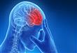  تعرف على أعراض وطرق علاج السكتة الدماغية