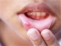 وجود قرحة أو قرح غير مؤلمة لا تندمل في الفم