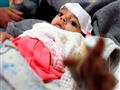 أكثر من مليون طفل يمني معرضون للموت بسبب الكوليرا