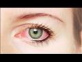 5 نصائح مهمة لمرضى حساسية العيون من تقلبات الجو هذ