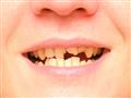   ماذا تفعل بالأسنان المخلوعة أو المكسورة؟