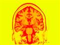 صورة رنين مغناطيسي لمخ مريض مصاب بالصرع