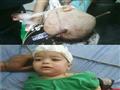 طفل السيخ الحديدي قبل إجراء العملية الجراحية